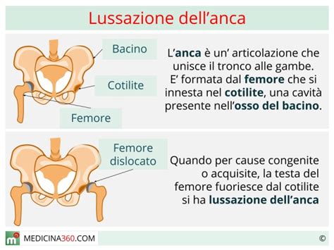 Lussazioni dell’anca 